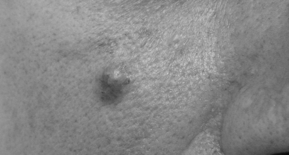 Exéresis Simple de Tumoración Cutánea